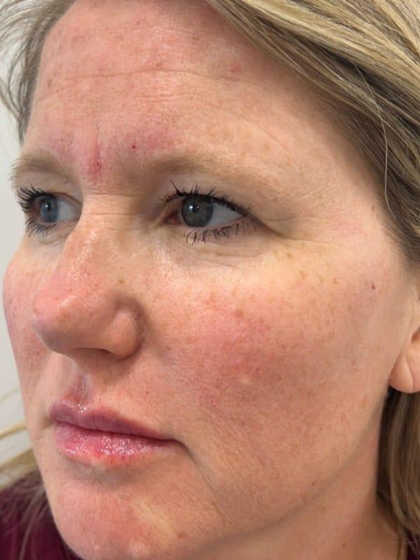 Juvederm after at Healthylooks Med Spa & Wellness in Lee's Summit, MO