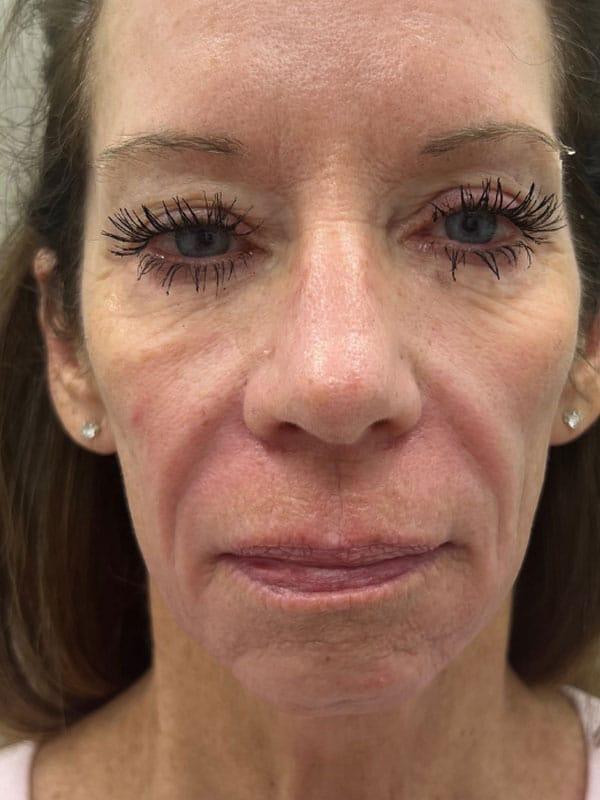 Mini Facelift after at Healthylooks Med Spa & Wellness in Lee's Summit, MO