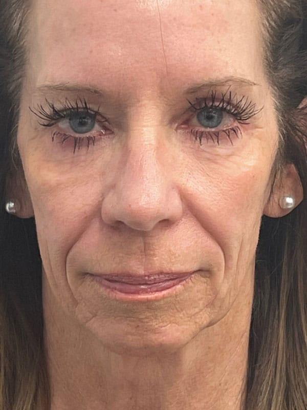 Mini Facelift before at Healthylooks Med Spa & Wellness in Lee's Summit, MO