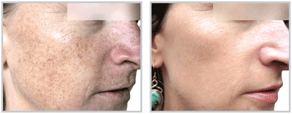 Healthylooks Med Spa & Wellness bbl result — Lee's Summit, MO