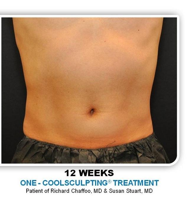 CoolSculpting after at Richard Chaffoo, MD, FACS, FICS in San Diego, CA