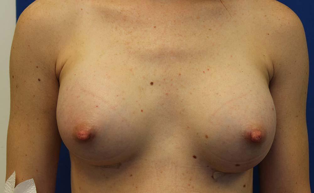 Richard Chaffoo, MD, FACS, FICS breast augmentation after — San Diego, CA