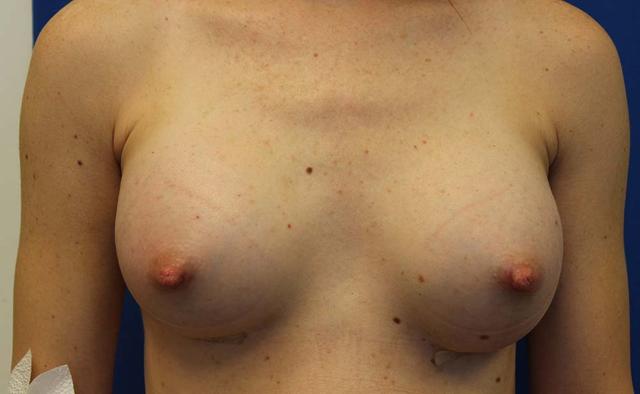 Breast Augmentation after at Richard Chaffoo, MD, FACS, FICS in San Diego, CA