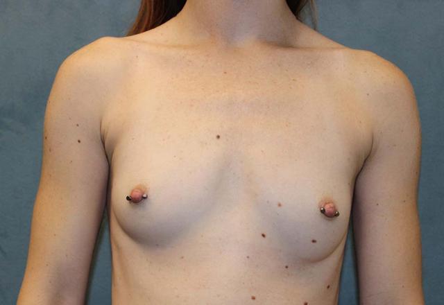 Breast Augmentation before at Richard Chaffoo, MD, FACS, FICS in San Diego, CA