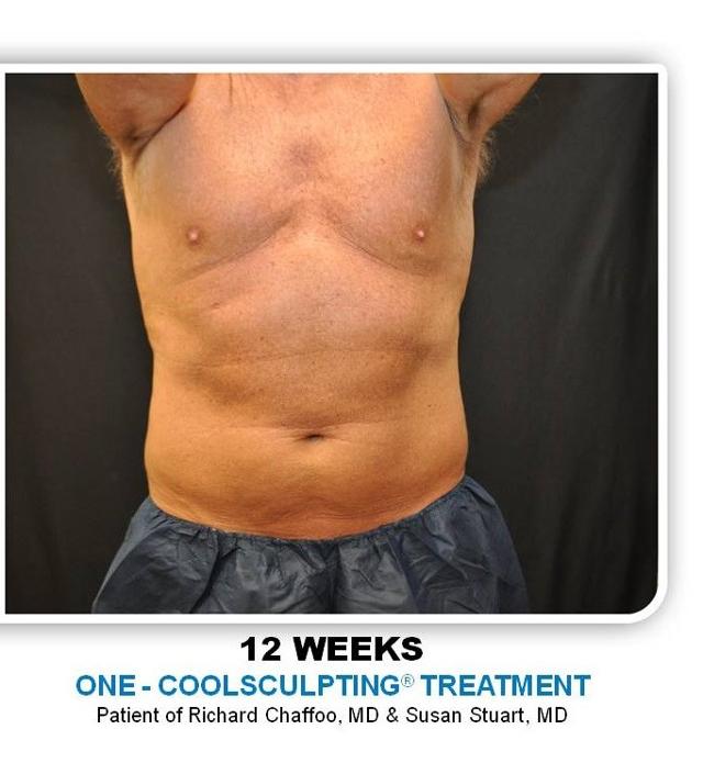 CoolSculpting after at Richard Chaffoo, MD, FACS, FICS in San Diego, CA