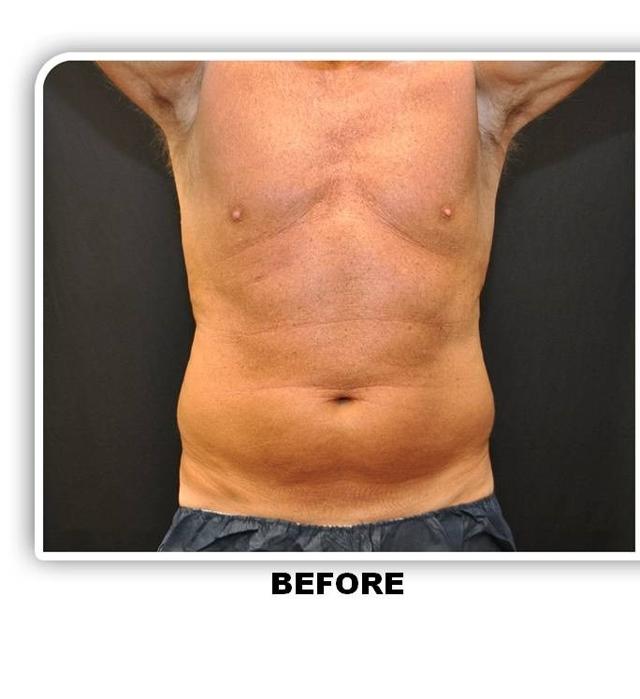 CoolSculpting before at Richard Chaffoo, MD, FACS, FICS in San Diego, CA