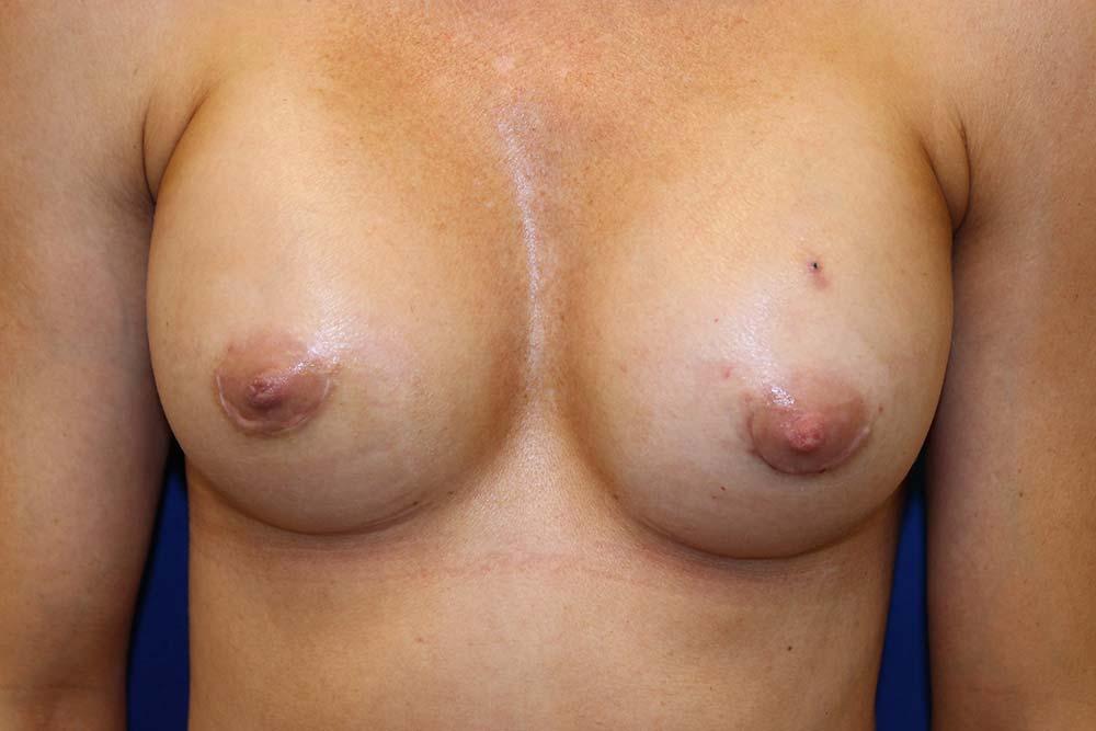 Richard Chaffoo, MD, FACS, FICS breast augmentation after — San Diego, CA