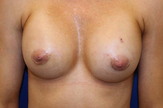 Breast Augmentation after at Richard Chaffoo, MD, FACS, FICS in San Diego, CA