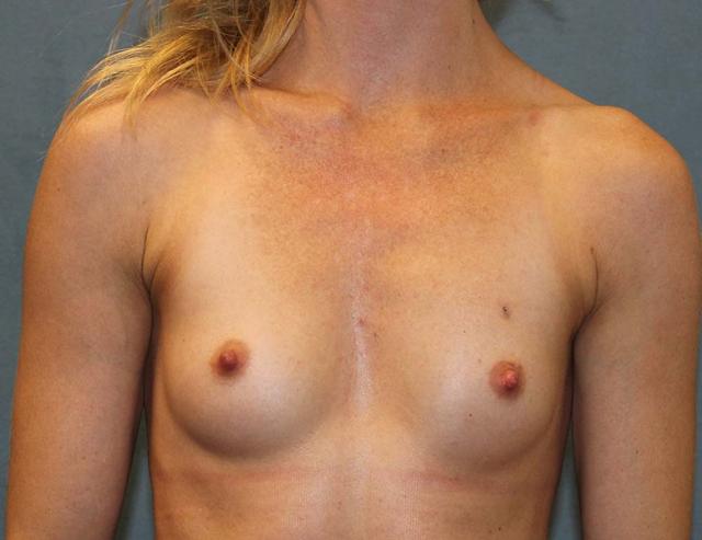 Breast Augmentation before at Richard Chaffoo, MD, FACS, FICS in San Diego, CA