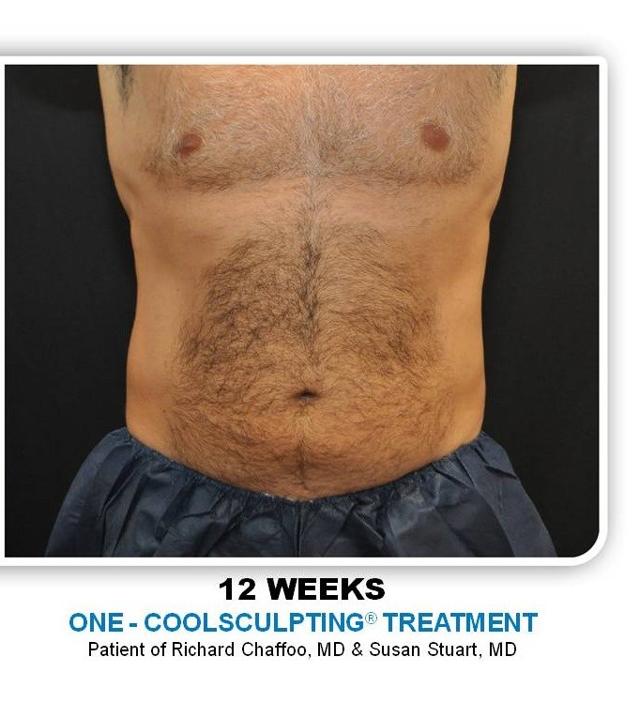 CoolSculpting after at Richard Chaffoo, MD, FACS, FICS in San Diego, CA