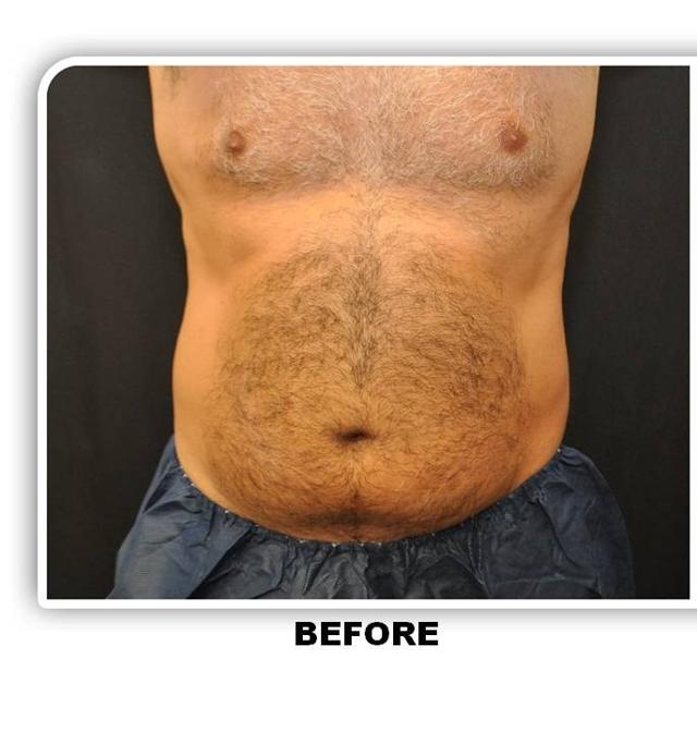 CoolSculpting before at Richard Chaffoo, MD, FACS, FICS in San Diego, CA