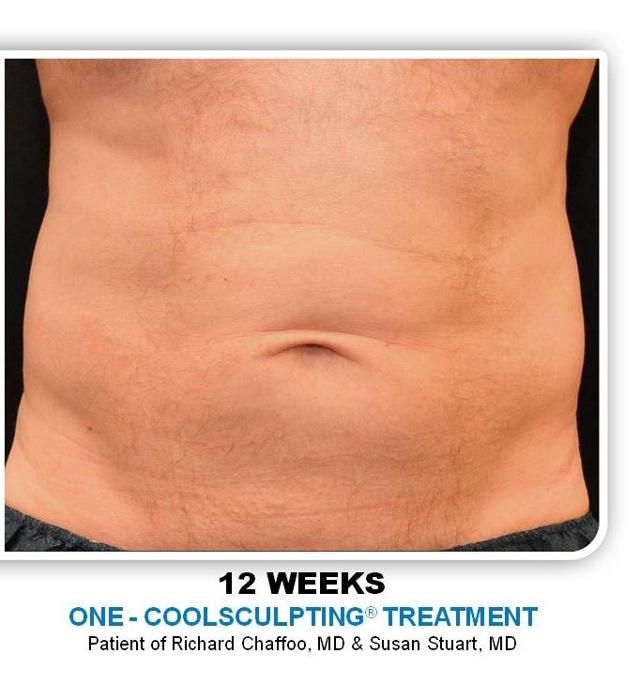 CoolSculpting after at Richard Chaffoo, MD, FACS, FICS in San Diego, CA