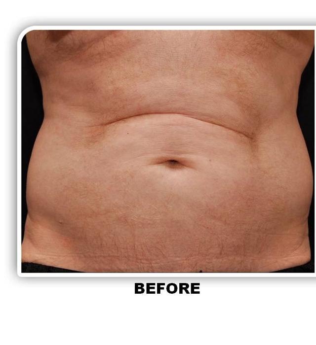 CoolSculpting before at Richard Chaffoo, MD, FACS, FICS in San Diego, CA