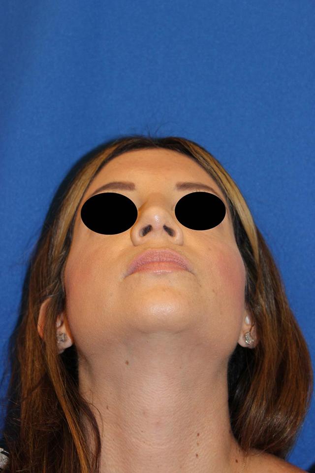 Rhinoplasty after at Richard Chaffoo, MD, FACS, FICS in San Diego, CA