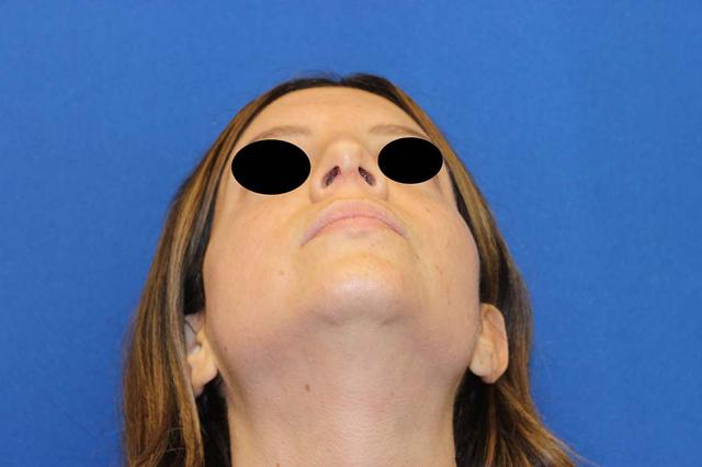 Rhinoplasty before at Richard Chaffoo, MD, FACS, FICS in San Diego, CA