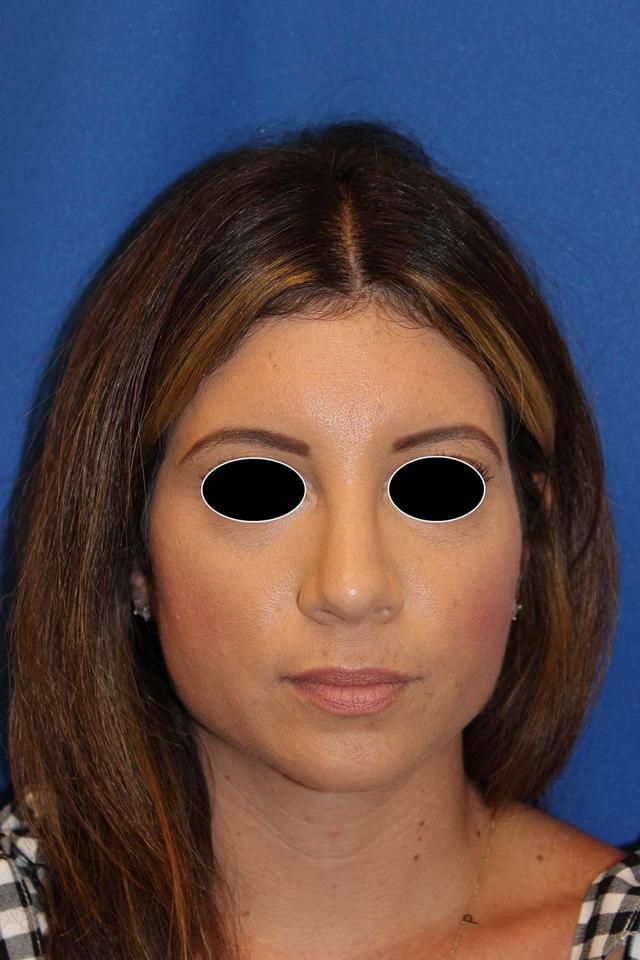 Rhinoplasty after at Richard Chaffoo, MD, FACS, FICS in San Diego, CA