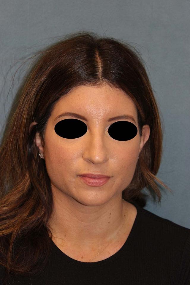 Rhinoplasty before at Richard Chaffoo, MD, FACS, FICS in San Diego, CA