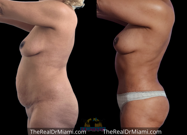Mini Tummy Tuck result at Dr. Miami - Michael Salzhauer in Bay Harbor Islands, FL