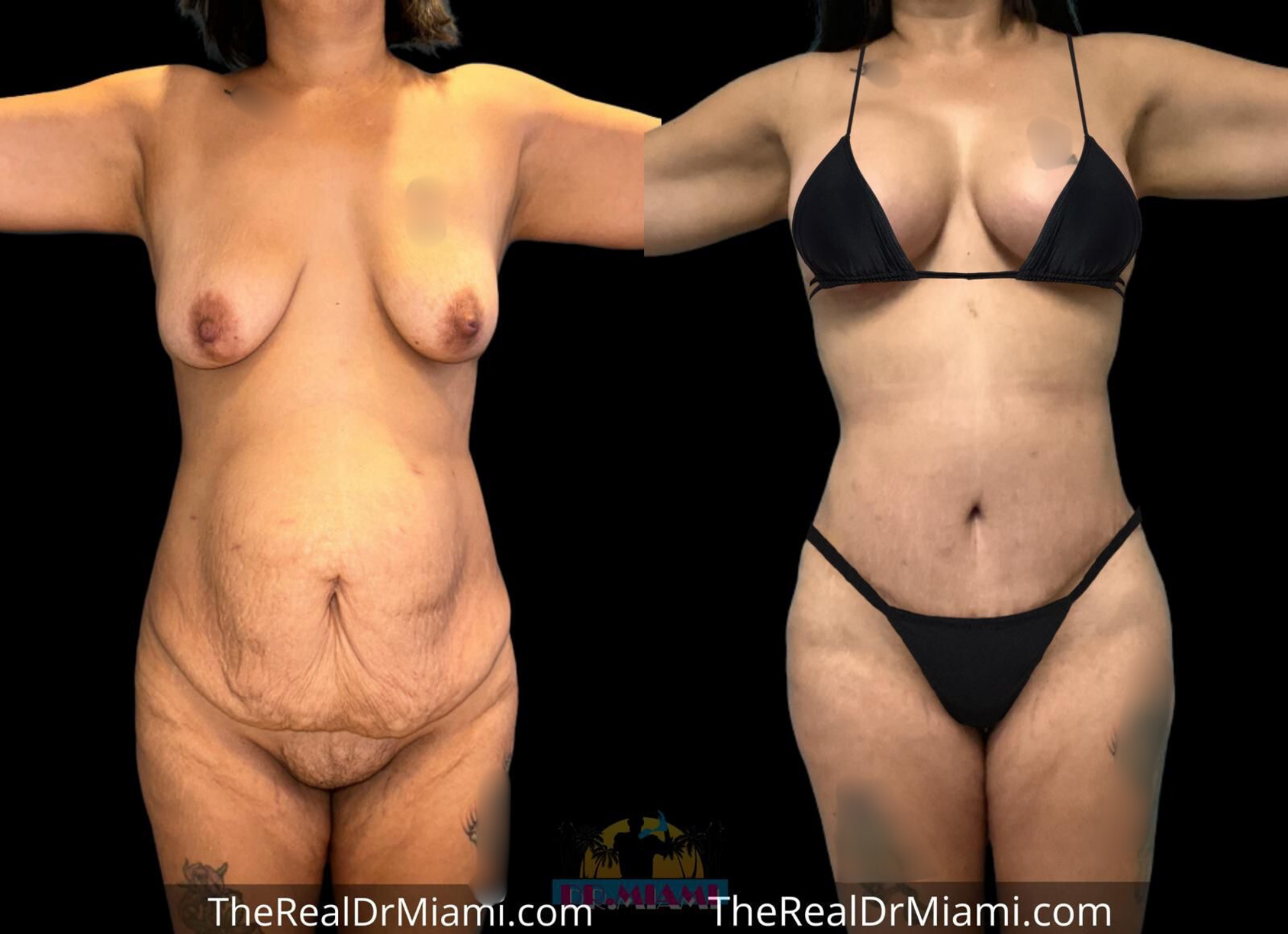 Dr. Miami - Michael Salzhauer mommy makeover result — Bay Harbor Islands, FL