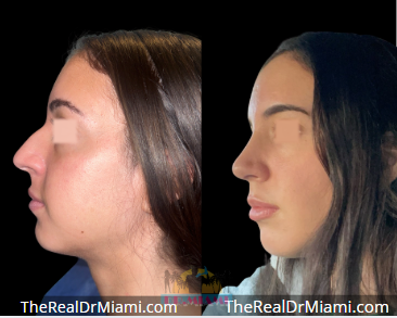 Rhinoplasty result at Dr. Miami - Michael Salzhauer in Bay Harbor Islands, FL