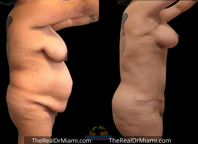 Mini Tummy Tuck result at Dr. Miami - Michael Salzhauer in Bay Harbor Islands, FL