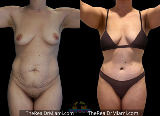 Mini Tummy Tuck result at Dr. Miami - Michael Salzhauer in Bay Harbor Islands, FL