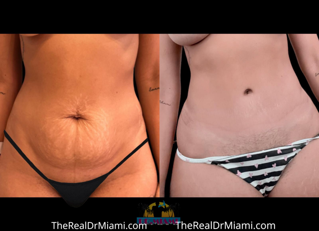 Mini Tummy Tuck result at Dr. Miami - Michael Salzhauer in Bay Harbor Islands, FL