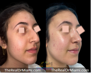Rhinoplasty result at Dr. Miami - Michael Salzhauer in Bay Harbor Islands, FL