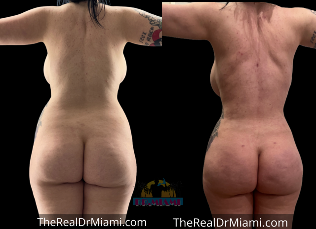 Brazilian Butt Lift result at Dr. Miami - Michael Salzhauer in Bay Harbor Islands, FL