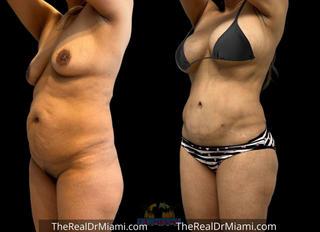 Mommy Makeover result at Dr. Miami - Michael Salzhauer in Bay Harbor Islands, FL