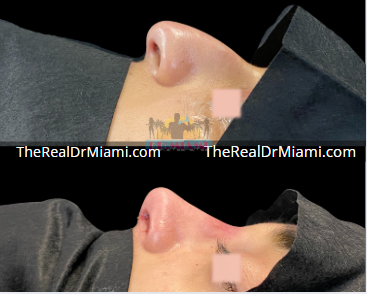 Rhinoplasty result at Dr. Miami - Michael Salzhauer in Bay Harbor Islands, FL