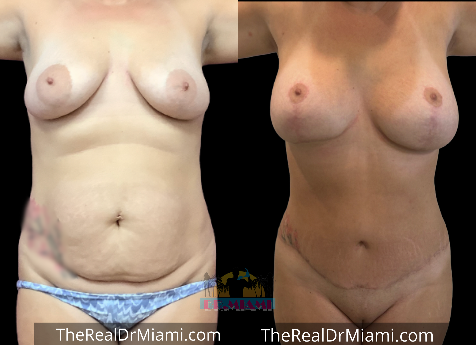 Dr. Miami - Michael Salzhauer mommy makeover result — Bay Harbor Islands, FL