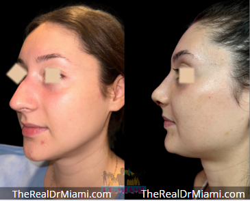 Rhinoplasty result at Dr. Miami - Michael Salzhauer in Bay Harbor Islands, FL