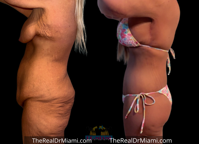 Mini Tummy Tuck result at Dr. Miami - Michael Salzhauer in Bay Harbor Islands, FL