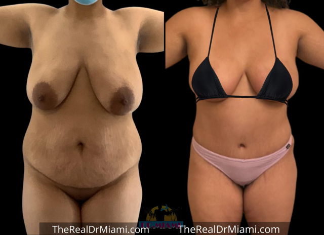 Mini Tummy Tuck result at Dr. Miami - Michael Salzhauer in Bay Harbor Islands, FL