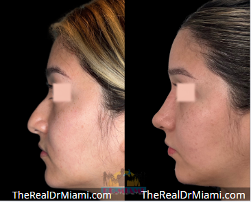 Rhinoplasty result at Dr. Miami - Michael Salzhauer in Bay Harbor Islands, FL