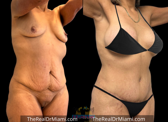 Mini Tummy Tuck result at Dr. Miami - Michael Salzhauer in Bay Harbor Islands, FL
