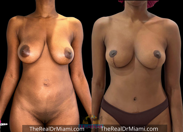 Mommy Makeover result at Dr. Miami - Michael Salzhauer in Bay Harbor Islands, FL
