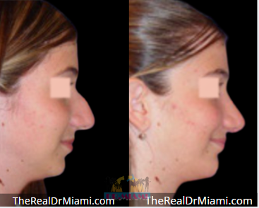 Rhinoplasty result at Dr. Miami - Michael Salzhauer in Bay Harbor Islands, FL