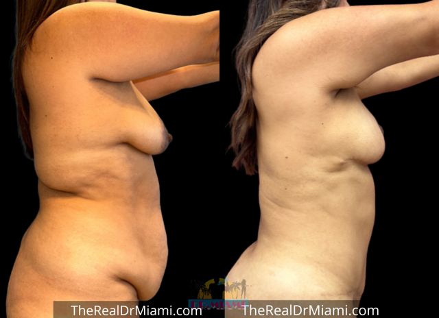 Mini Tummy Tuck result at Dr. Miami - Michael Salzhauer in Bay Harbor Islands, FL