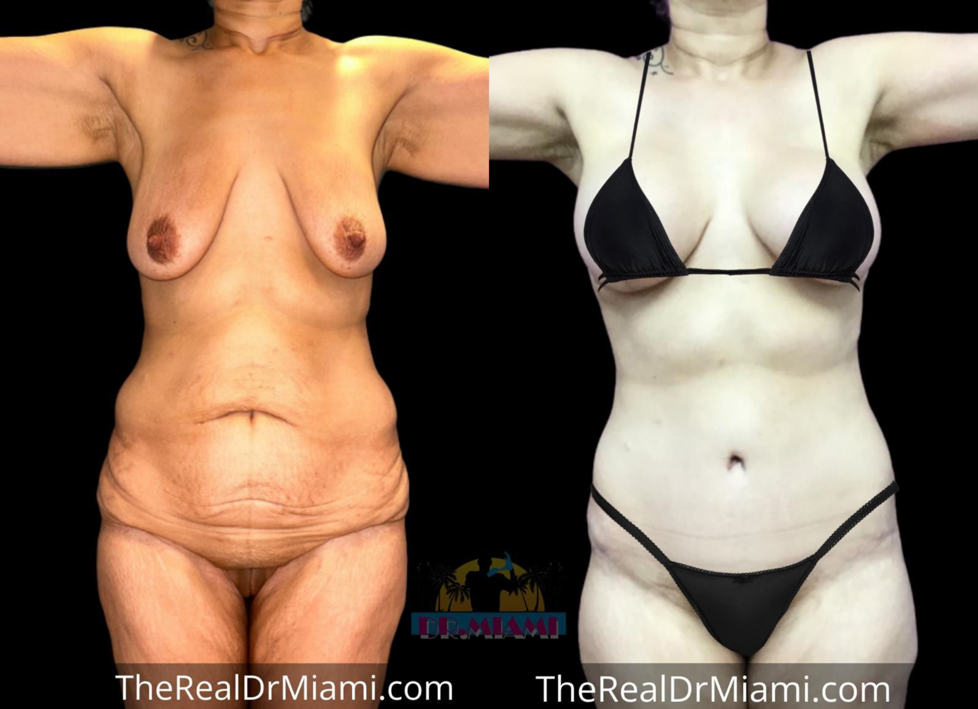 Dr. Miami - Michael Salzhauer mommy makeover result — Bay Harbor Islands, FL