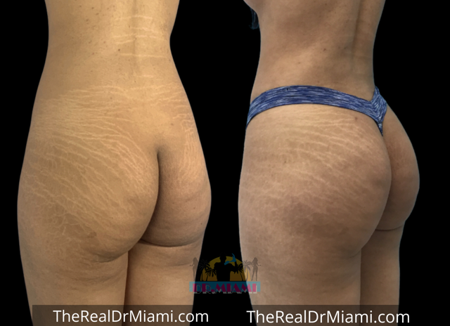Brazilian Butt Lift result at Dr. Miami - Michael Salzhauer in Bay Harbor Islands, FL