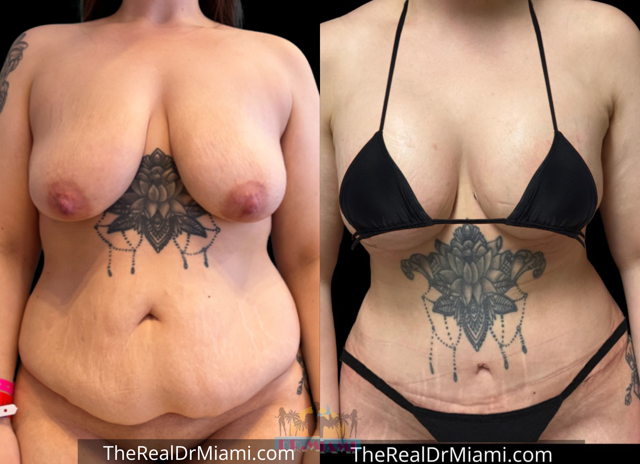 Mini Tummy Tuck result at Dr. Miami - Michael Salzhauer in Bay Harbor Islands, FL