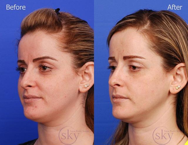 Neck Liposuction result at SKY Facial Plastic Surgery in San Diego, CA
