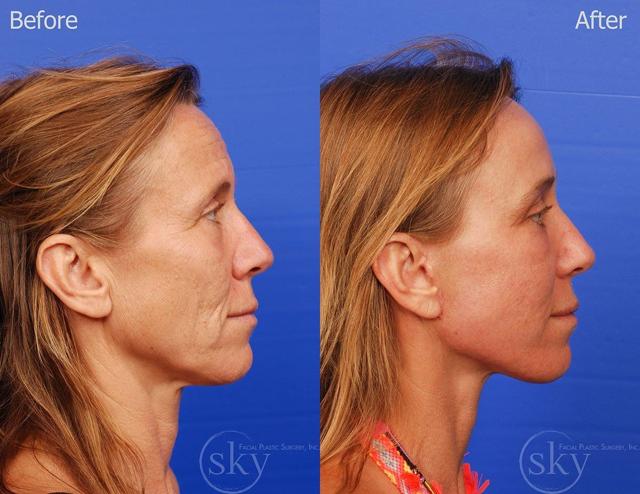 Laser Skin Resurfacing result at SKY Facial Plastic Surgery in San Diego, CA