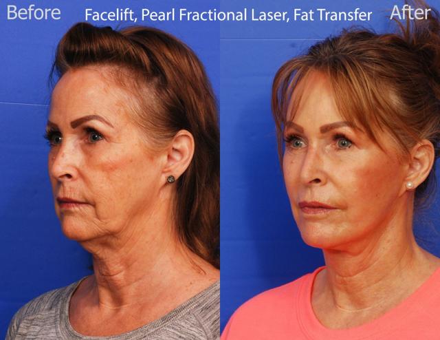 Facelift result at SKY Facial Plastic Surgery in San Diego, CA