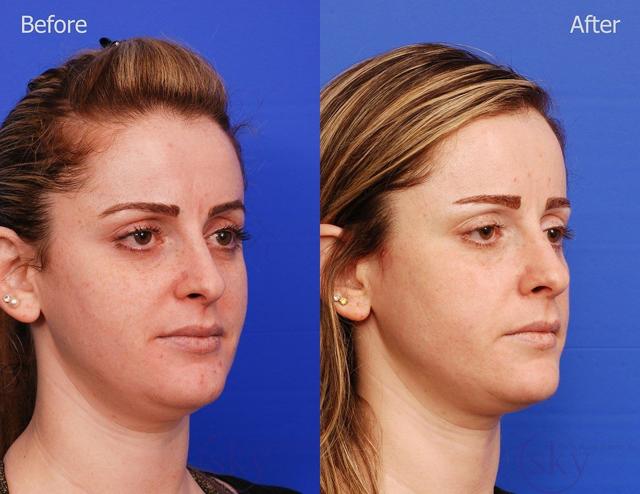 Neck Liposuction result at SKY Facial Plastic Surgery in San Diego, CA