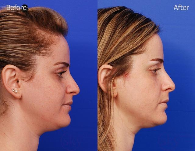 Neck Liposuction result at SKY Facial Plastic Surgery in San Diego, CA
