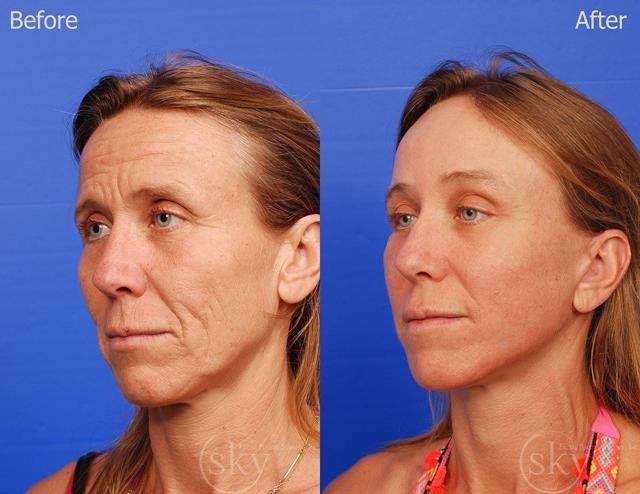 Laser Skin Resurfacing result at SKY Facial Plastic Surgery in San Diego, CA