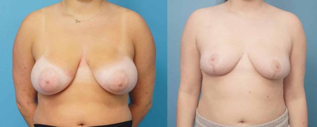 Breast Reduction result at Mark Sisco, MD in Northbrook, IL